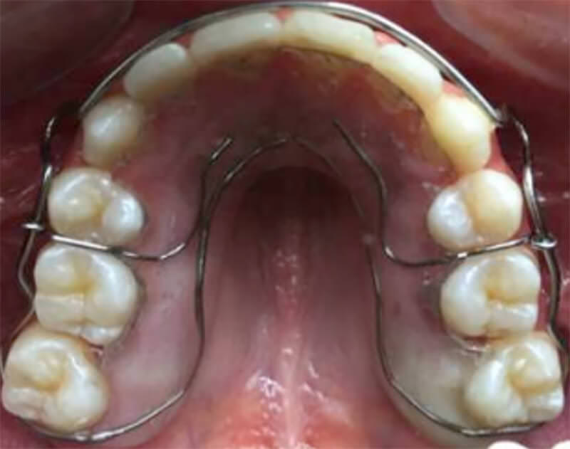 Fig. 16 Retenedores circunferenciales