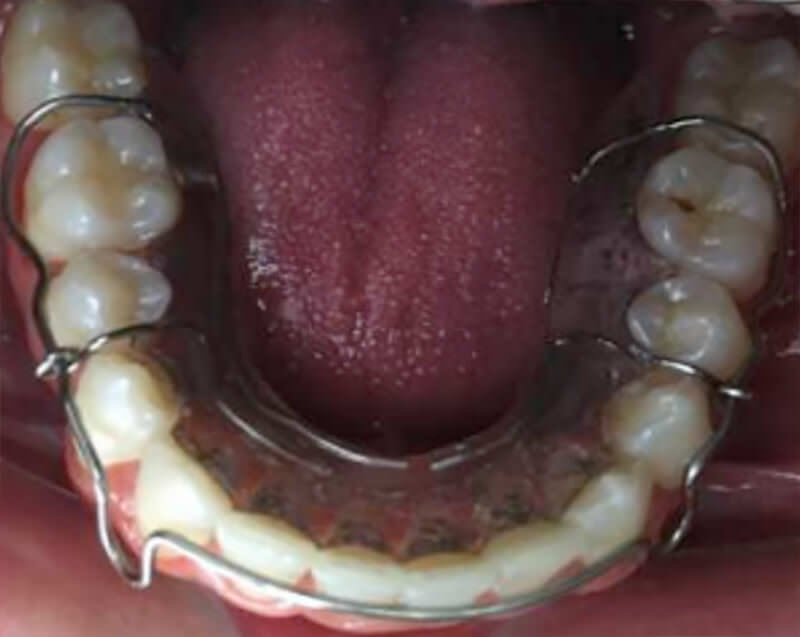 Fig. 16 Retenedores circunferenciales