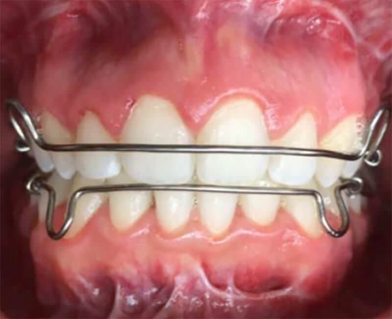 Fig. 16 Retenedores circunferenciales