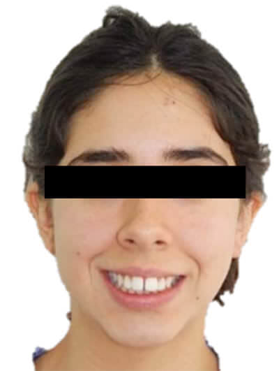 Fig. 3 Sonrisa inicio