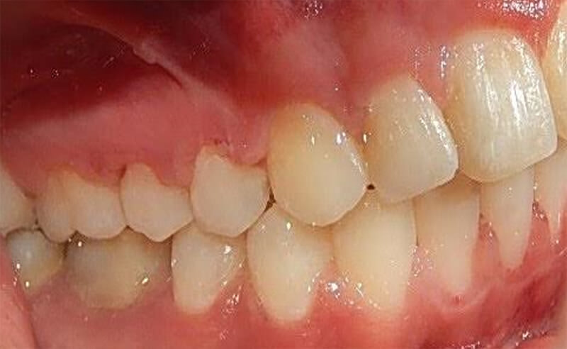 Fig. 13 Derecha