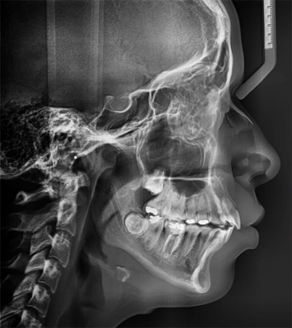 Fig. 15 Rx lateral de cráneo final