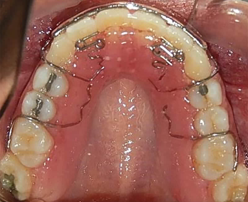 Fig. 16: Retenedor Halley vista oclusal