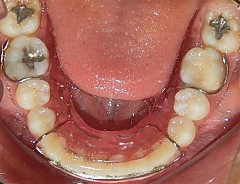 Fig. 17. Halley inferior vista oclusal