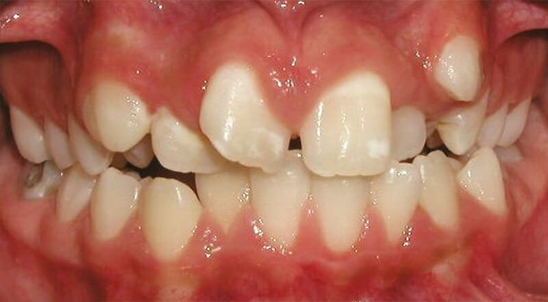 Fig. 3: Intraoral de frente