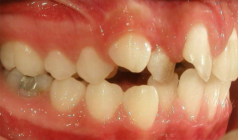 Fig. 4: Intraoral derecha