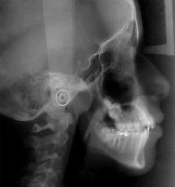 Fig. 6: Radiografía lateral de cráneo inicio