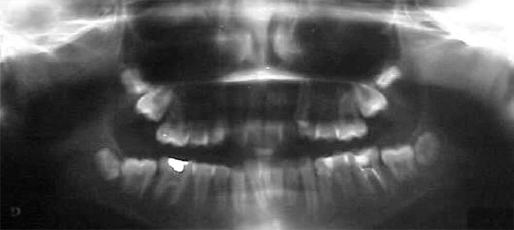 Fig. 7: Radiografía panorámica inicio