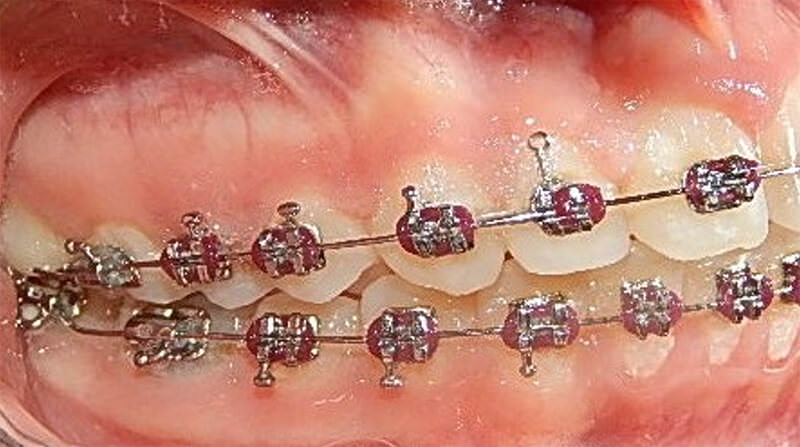 Fig. 8: Progreso intraoral lateral derecha