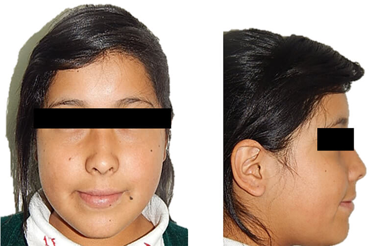 Fig 1. Extraoral de frente y perfil