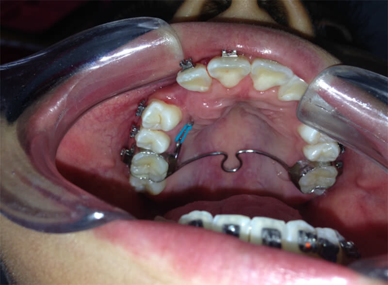 Fig 11. Tracción ortodóntica