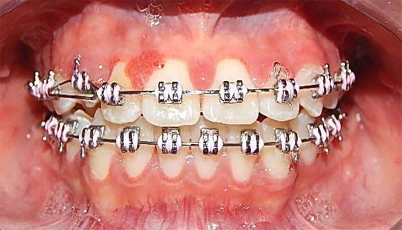 Fig 13. Progreso intraoral de frente