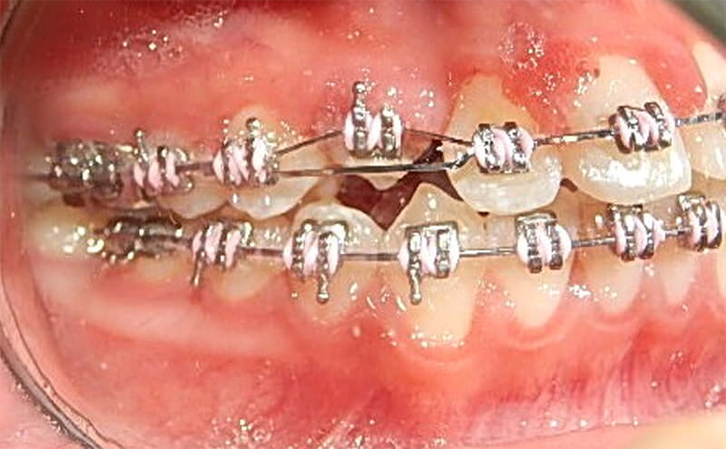 Fig 14a. Intraoral derecha con la aparatología utilizada