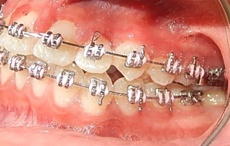 Fig 14b. Intraoral izquierda con la aparatología utilizada