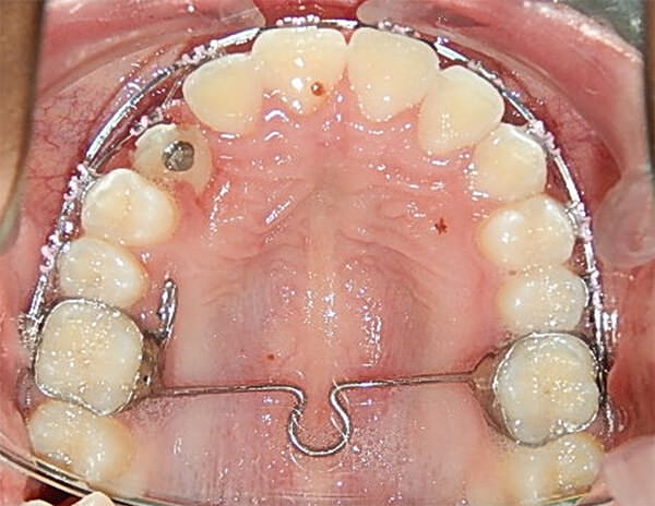 Fig 17. Arco Transpalatino modificado con brazo de tracccion de lado derecho