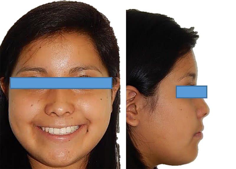 Fig 18. Extraoral de sonrisa y perfil