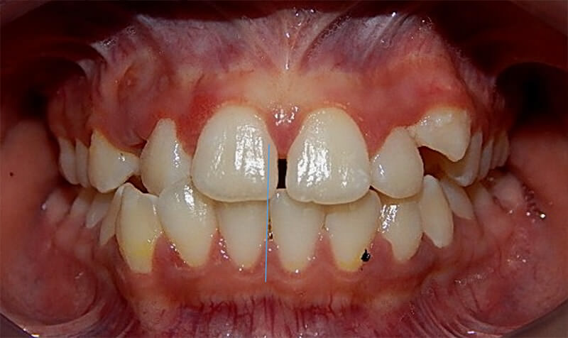 Fig 2. Intraoral de frente