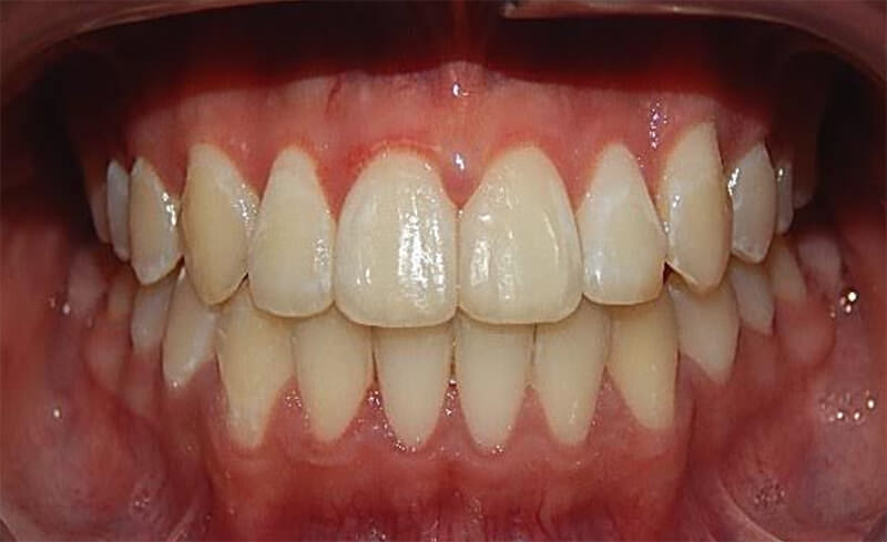 Fig 19. Intraoral final de frente