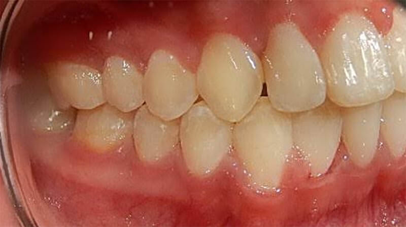 Fig 20a. Intraoral lateral derecha final