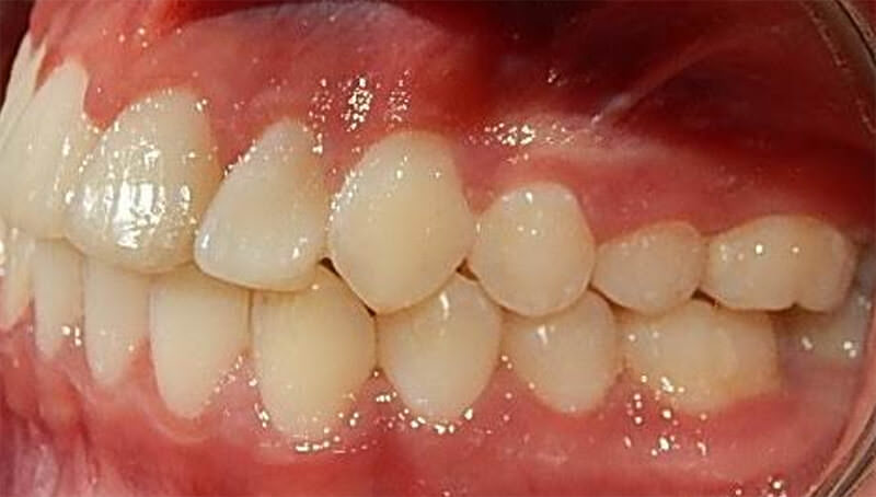 Fig 20b. Intraoral lateral izquierda final