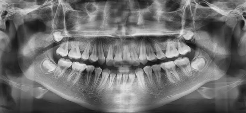 Fig 22. Radiografía Panorámica