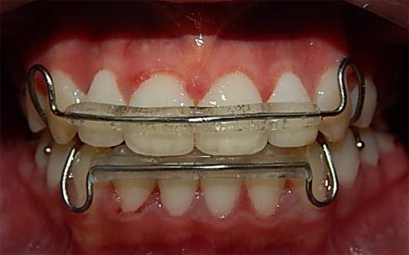 Fig 23. Vista de frente con retenedor circunferencial y Hawley