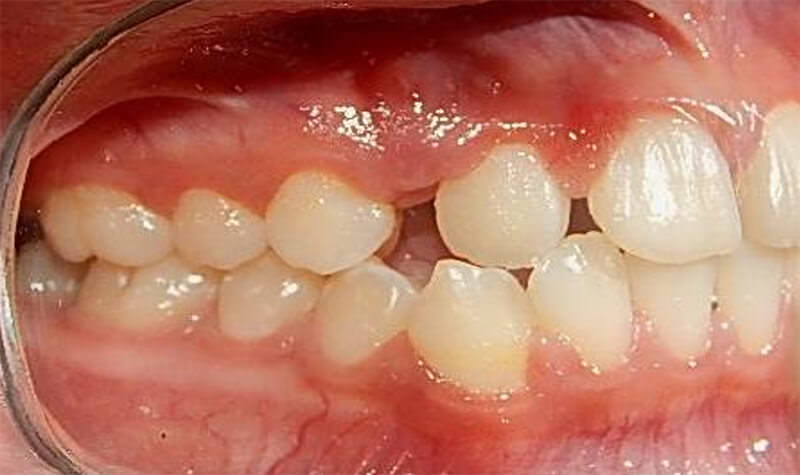 Fig 3. Intraoral derecha