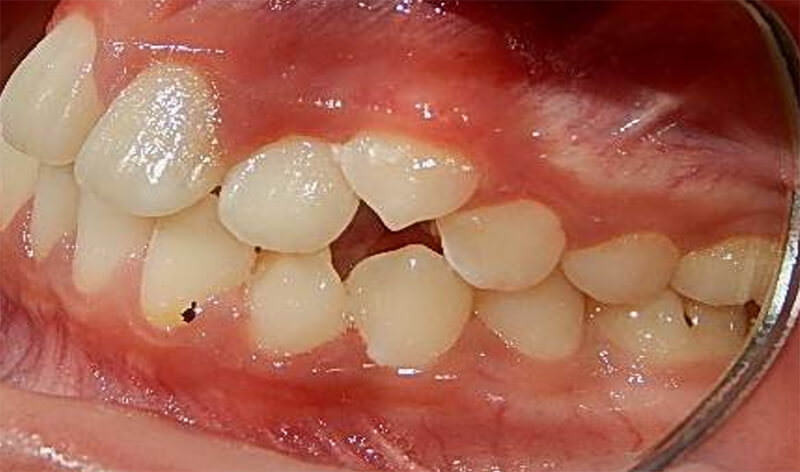 Fig 4. Intraoral izquierda