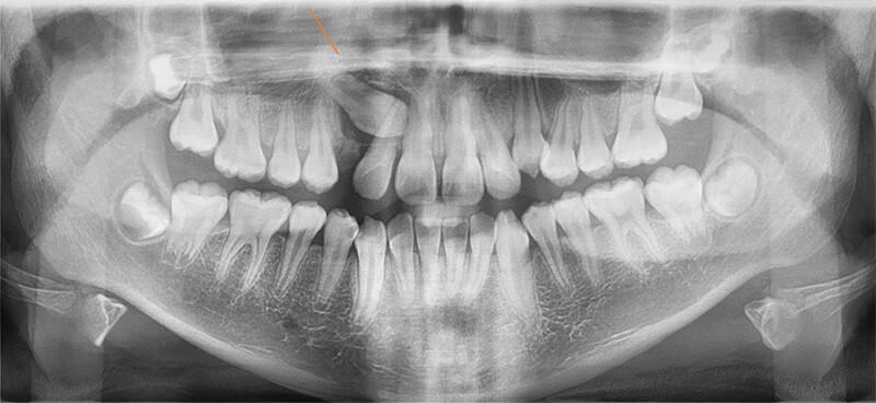 Fig 6. Radiografía panorámica