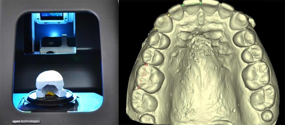 Imagen 3. Modelos digitales obtenidos escáner extraoral Dental Scanner SMART