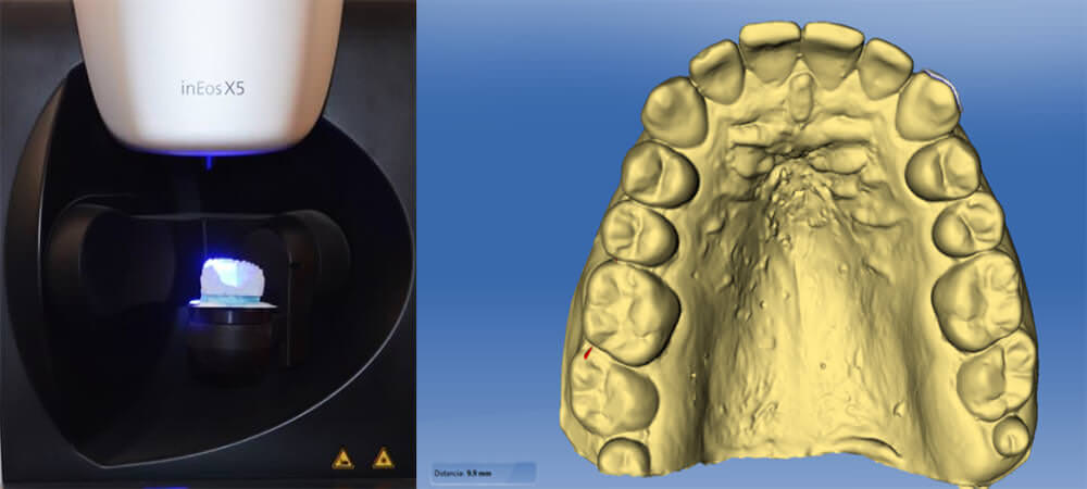 Imagen 4. Escáner extraoral inEos y  Modelos digitales obtenido