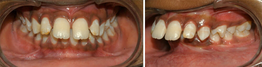 Fig.5 Intraoral Frontal, Fig.6: Intraoral Left Buccal view