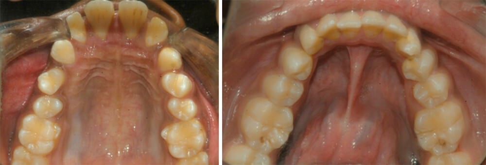 Fif.7 Intraoral Maxillary Occlusal, Fig.8 Intraoral Mandibular Occlusal