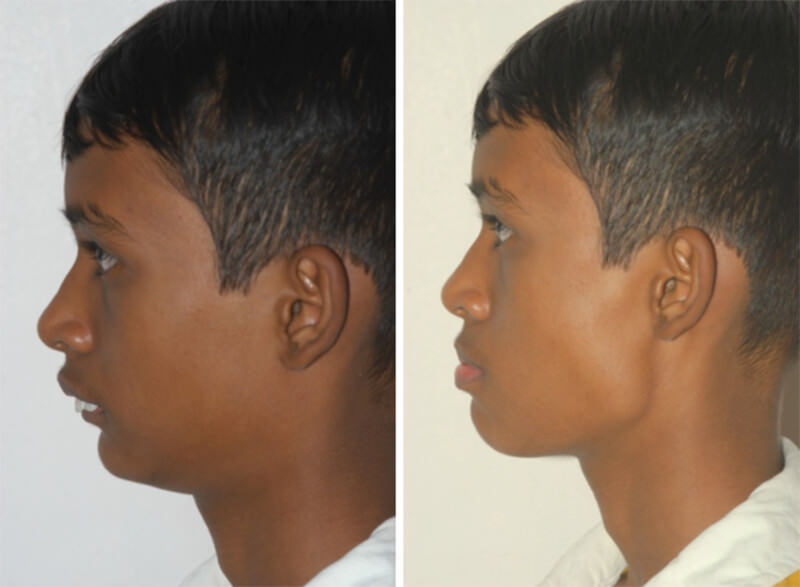 Fig.9 Pretreatment profile view, Fig.10 Visual Treatment Objective : Positive