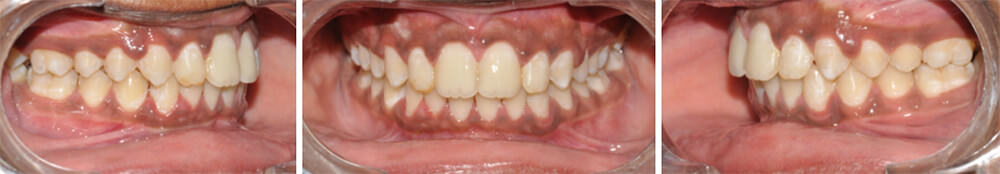 Fig.20 Post treatment Intra oral buccal view right, Fig.21 Post treatment Intra oral Frontal, Fig.22 Post treatment Intra oral buccal view left