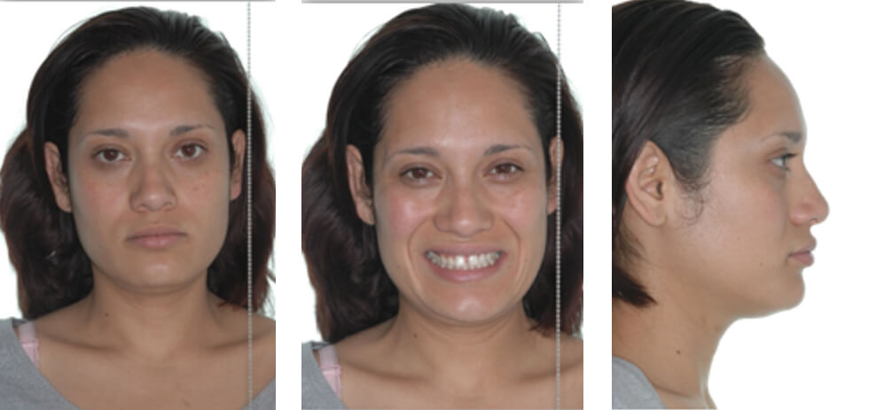 Figura 1. Fotografías extraorales, frontal y lateral del paciente.