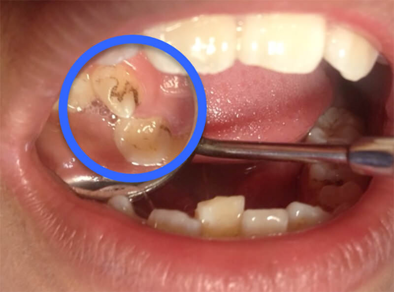Imagen I: Paciente con pigmentaciones en las caras palatinas de los dientes anteriores