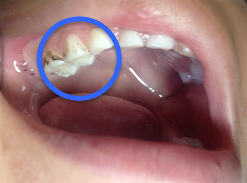 Imagen II: Pacientes con pigmentaciones en las caras vestibulares de los molares superiores temporales derechos
