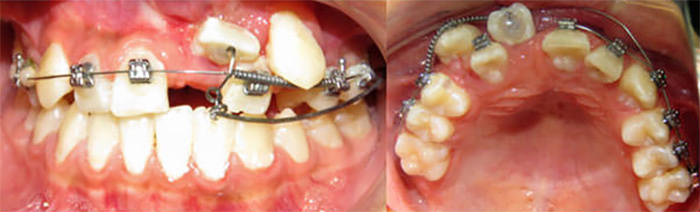 Figura 13: Brazo de poder colocado del tubo accesorio del molar (26) a órgano dentario incluido (21)