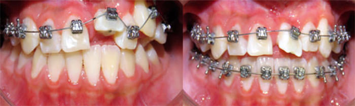 Figura 14: Inclusión del órgano dentario 21 a la aparotología ortodóncia Damon