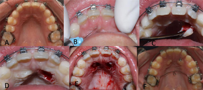 Figura 4: A. Fotografía inicial. B. Colocación de Anestesia Lidocaína al 2%. C. Levantamiento de colgado. D. Ventana Quirúrgica. E. Osteotomía y descubrimiento de canino retenido para tracción. F. Erupción autónoma de Canino después de dos meses.