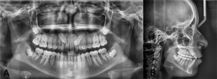 Figura 5: Radiografía Panorámica. B. Radiografía Letaral