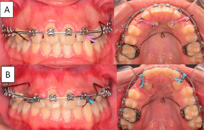 Figura 6: Fotografías Frontal y Oclusal con método de tracción A) antes B) después de 3 meses de tratamiento