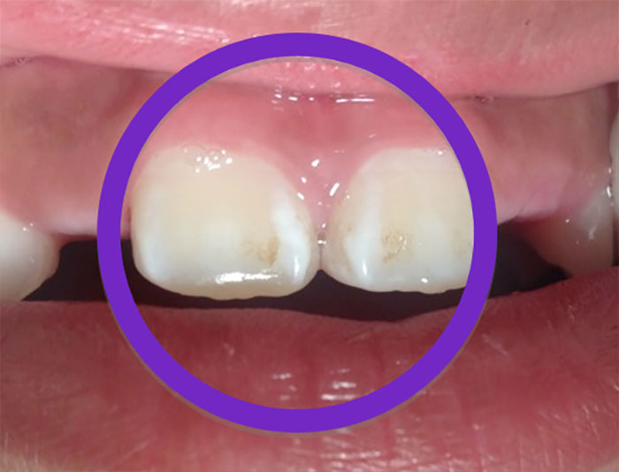 Imagen III: Fluorosis