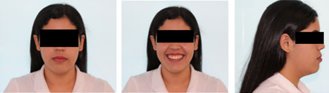 Figura 9 Fotografías faciales al final del tratamiento