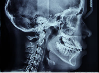 Figura 3 Radiografía lateral de cráneo pretratamiento