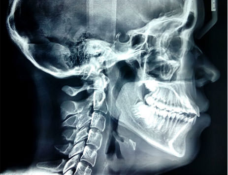 Figura 7 Radiografía lateral de cráneo al finalizar el tratamiento