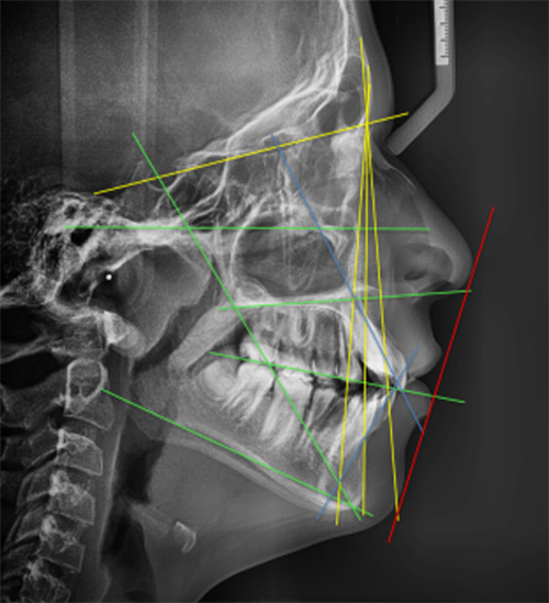 Fig 1. Radiografía lateral de cráneo