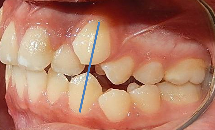 Fig. 13 lateral derecha de inicio