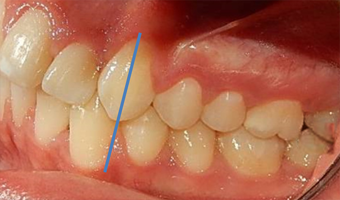 Fig. 14 lateral derecha final